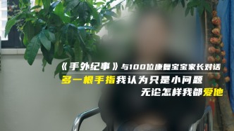 多一根手指我認為只是小問題，無論怎樣我都愛他