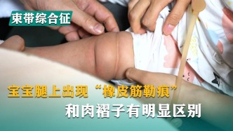 寶寶腿上出現(xiàn)“橡皮筋勒痕”，和肉褶子有明顯區(qū)別