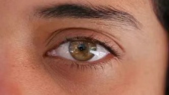 翼状胬肉——不痛不痒的视力杀手