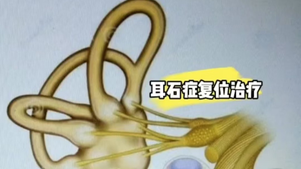 “耳石癥”立竿見影的治療方法——耳石復(fù)位治療