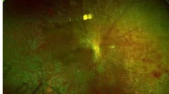 警惕“甜蜜的致盲杀手”——糖尿病性视网膜病变