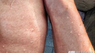 奇怪，为什么只有一边胳膊爱出汗？