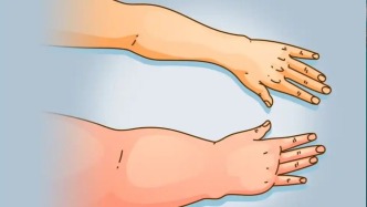 康復科護士的防腫“黑皮書”——乳腺癌術后淋巴水腫的攻防戰(zhàn)