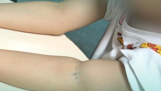 羊膜帶纏繞可能會壓迫神經(jīng)，小時候還以為是臍帶勒的