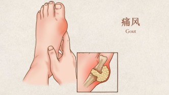管住嘴≠萬(wàn)事大吉：痛風(fēng)的飲食誤區(qū)與科學(xué)應(yīng)對(duì)