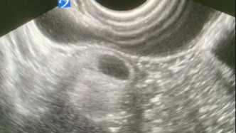 “去而复返”的畸胎瘤引发的思考