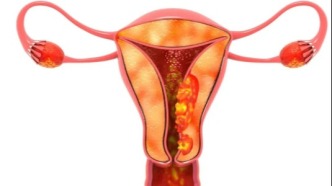 年輕女子突發高熱昏迷，背后“真兇”竟是這種婦科腫瘤