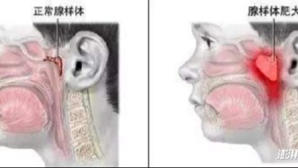 案例 | 13岁男孩不敢照镜子：一张被张口呼吸毁掉的脸