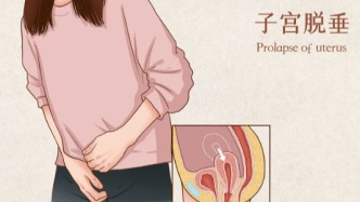 科普 | “子宫掉下来”是咋回事？这种妇科问题，多见于经产妇、老年女性及长期腹压增高者