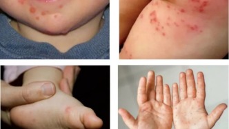 進入高發(fā)期！