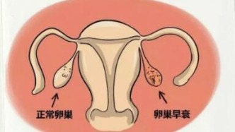 卵巢早衰的“元兇”就在身邊？