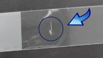 科普 | 自閉了！眼里長蟲子，3條，活的那種