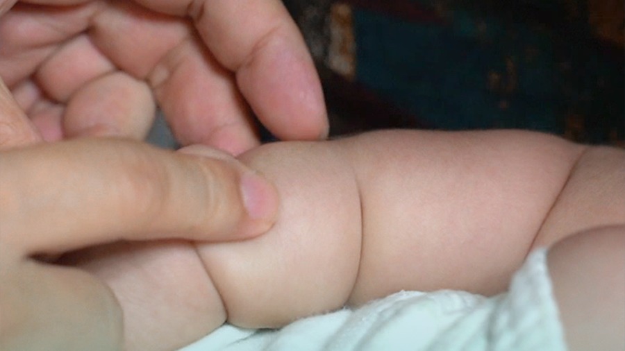 宝宝太胖以为是束带综合征,家长问他为啥胖得和别人不一样