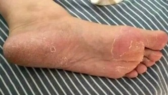 身上出現(xiàn)這些癥狀，說明你已經(jīng)缺乏B族維生素了