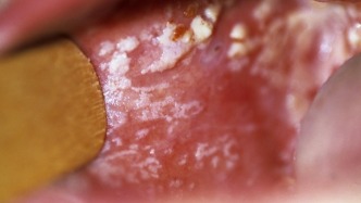 做活檢能確診白塞病嗎？大夫直言：這還真不好說！