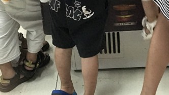 白塞病色素沉淀是怎么回事？