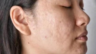 國(guó)產(chǎn)首款痤瘡疫苗要來(lái)了，“月球臉”終于有救了？