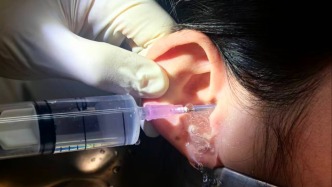 耳屎堵住了怎么办？