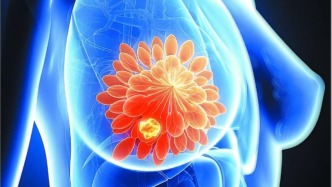 乳腺结节多久会癌变？出现这几个信号，说明离乳腺癌不远了