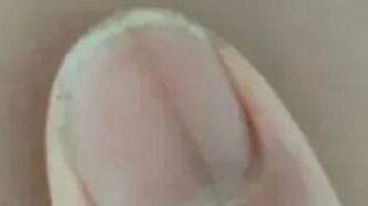 快自查！指甲一個(gè)小變化！可能是癌變！