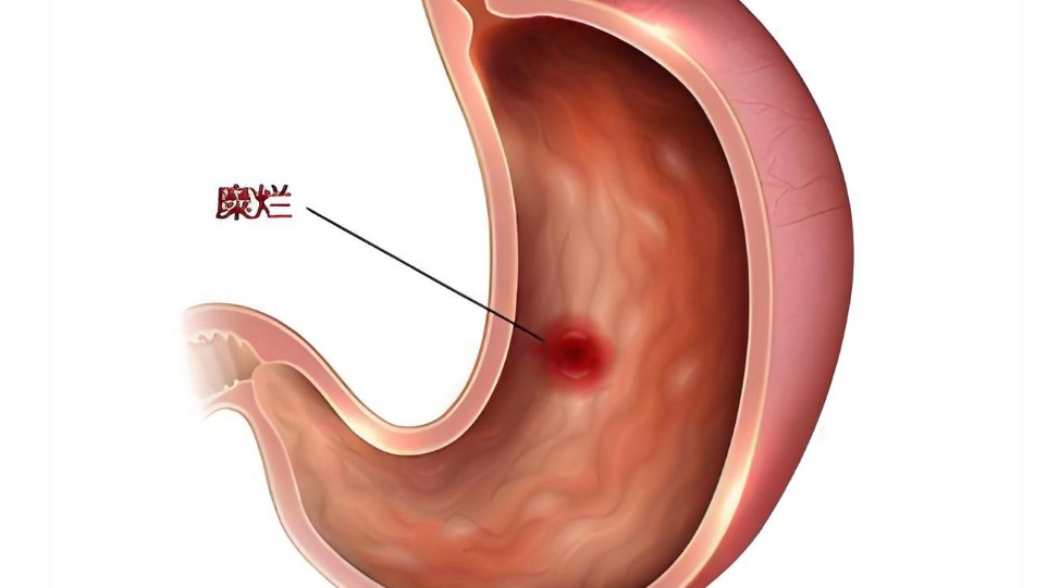 張旭亮：糜爛性胃炎的患者，改掉這3個習(xí)慣，胃病恢復(fù)快一倍