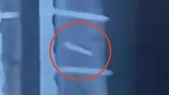 法治熱點(diǎn)|“手術(shù)鉆頭斷裂遺留患者體內(nèi)”，官方通報(bào)