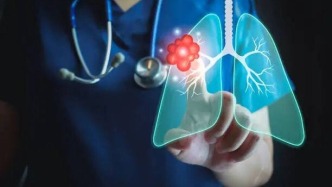 4.5個月內(nèi)6次自體NK細(xì)胞回輸后，晚期肺癌病灶體積減少約50%