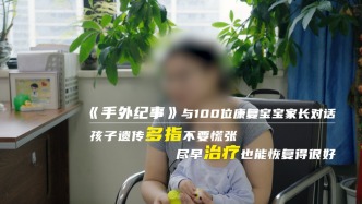 孩子遗传多指不要慌张，尽早治疗也能恢复得很好