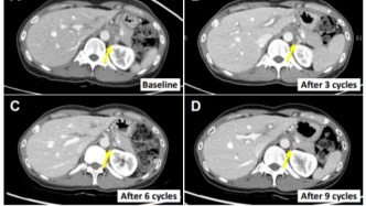 40名晚期膽道癌患者接受NK細胞聯(lián)合治療后，應(yīng)答率超50%，部分患者甚至腫瘤縮小或完全消失
