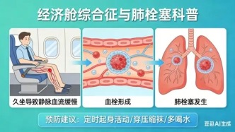 久坐、少喝水、愛硬扛？打工牛馬警惕“經(jīng)濟艙綜合征”