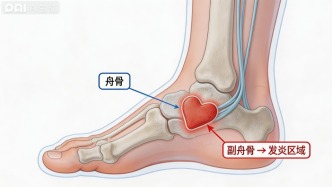 脚底的“不定时炸弹”：带你全面认识足副舟骨痛综合征