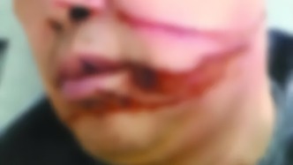 警惕！男子騎摩托過橋時(shí)被割臉，“兇器”又是它