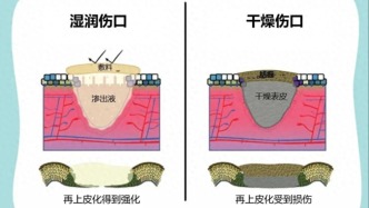 科普｜傷口晾干好，還是保濕好？很多人第一步就錯(cuò)了