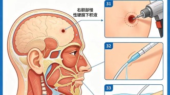 一文看懂什么是颅脑慢性硬膜下积液