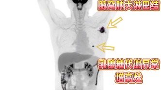 男人会得乳腺癌么？