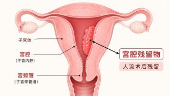 人流术后宫腔残留，该手术还是再等等？结合最新指南说清楚
