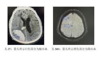 微出血VS脑出血：蚊子叮VS拳头打，差别大了