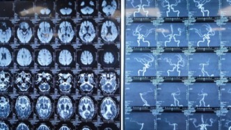 病例分享丨脑梗死恢复期半身不遂患者中西医结合康复治疗一例