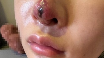 女子隆鼻后淤青眼肿，上海桉锘美说不用管、马应龙痔疮膏涂满 最终被公立医院诊断为并发症，面临毁容风险