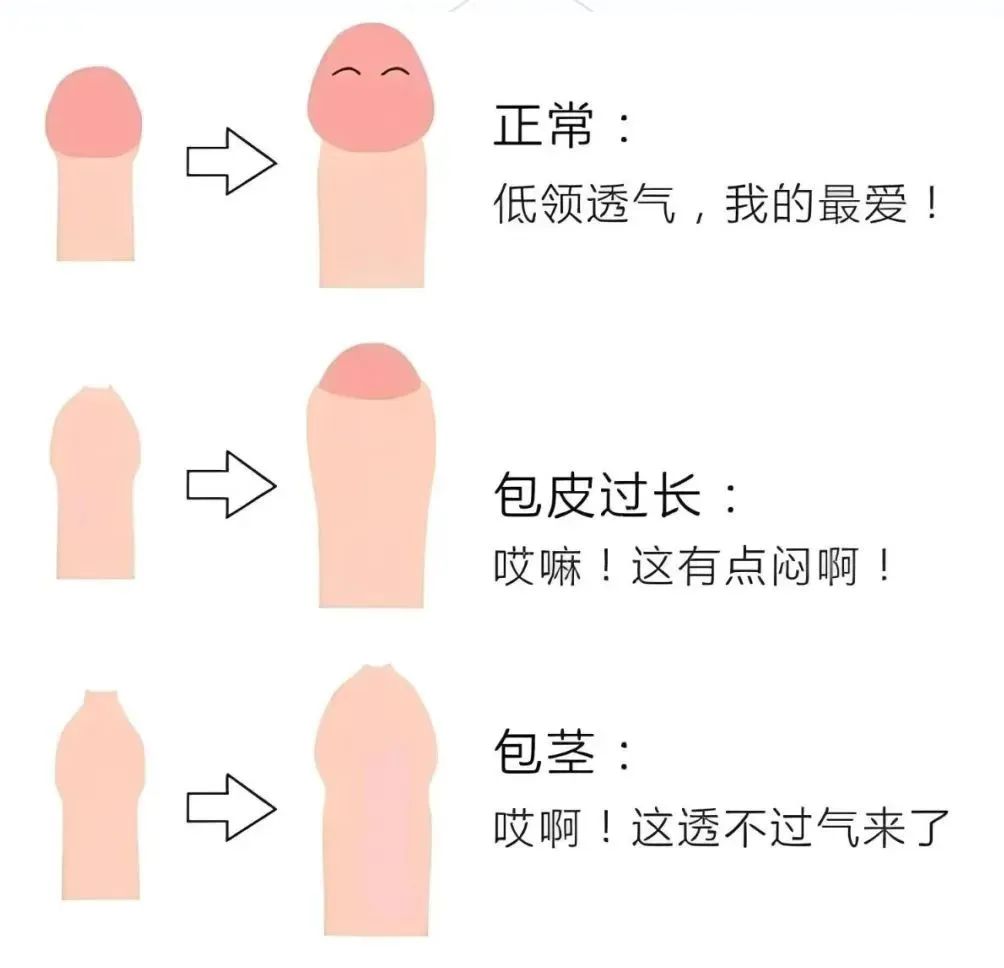 为什么要割包皮 为什么要割包皮