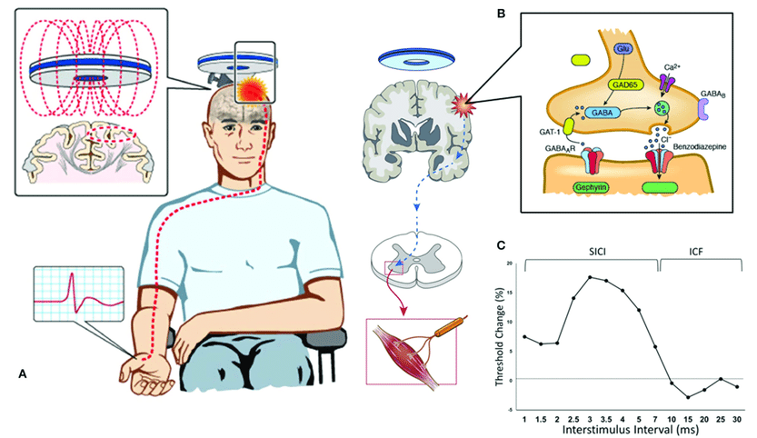 磁脉冲是什么经颅磁刺激中的总刺激个数和刺激脉冲数一样吗？_https://www.jmylbn.com_新闻资讯_第1张