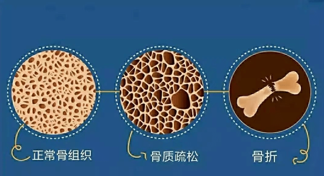 绝经后骨质疏松:这样护骨,远离骨折风险_澎湃号·湃客_澎湃新闻-The Paper