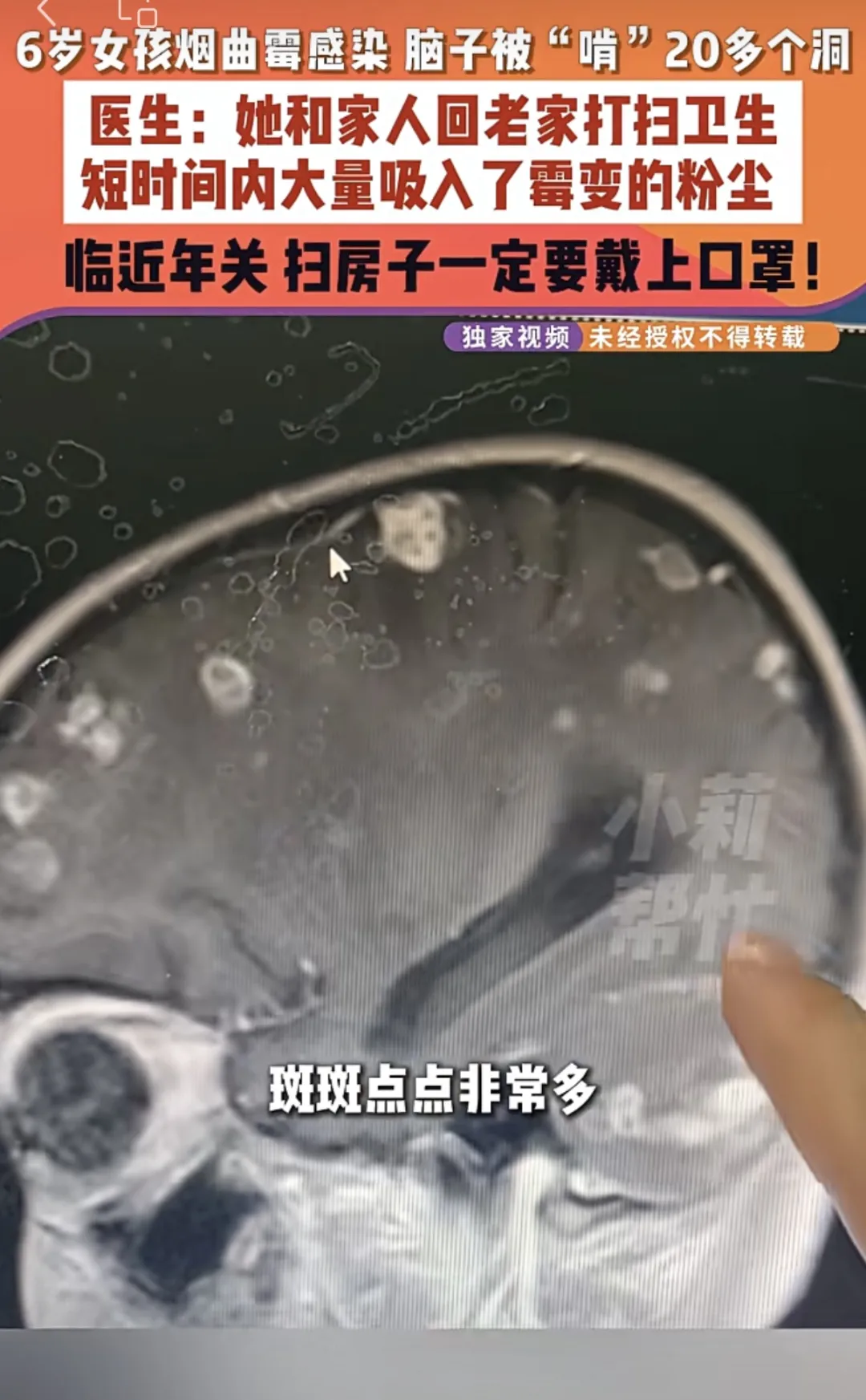 【健康科普】年前“大扫除”要警惕！6岁女孩发烧17天，医生紧急提醒→