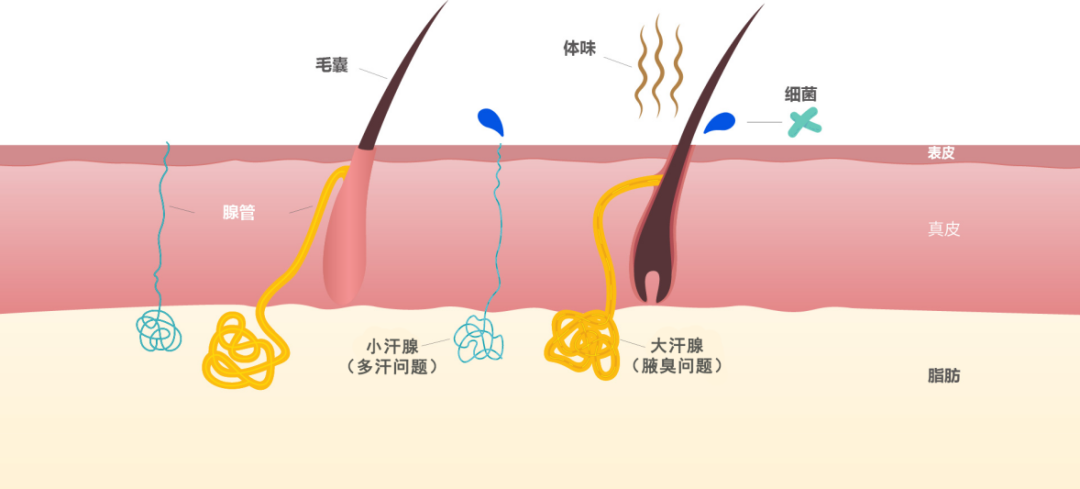一“腋”知春:解开多汗与异味的困扰