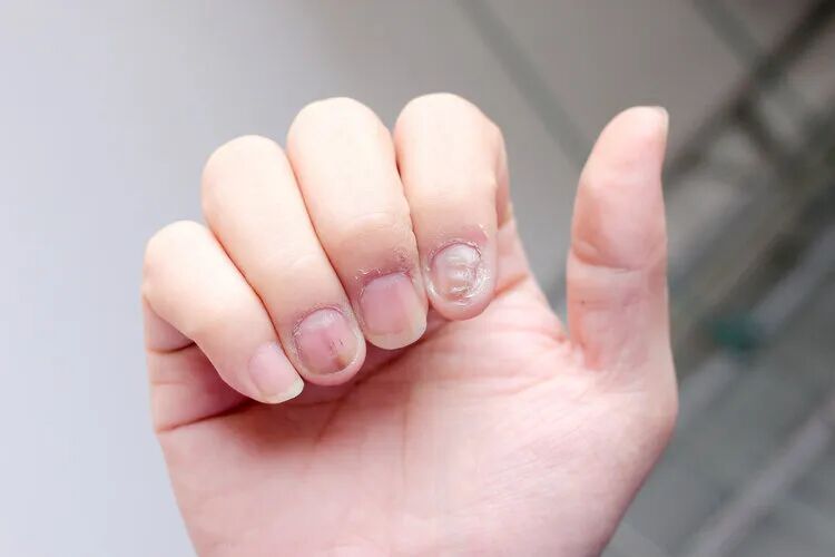 被癌症盯上的人,手脚易冰凉?手脚若有5种表现,可能是癌症预警_澎湃号·湃客_澎湃新闻-The Paper