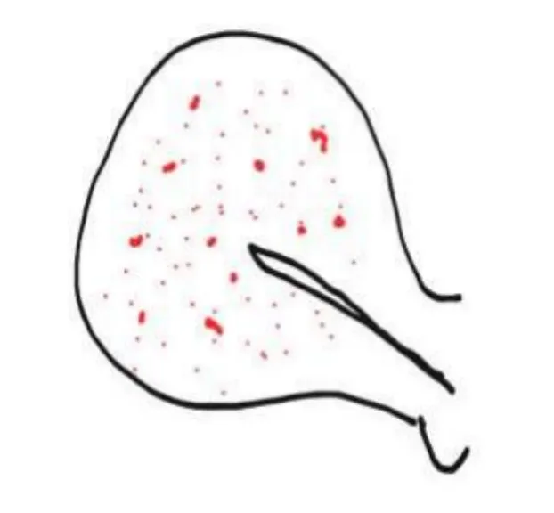 反复试管失败、腺肌病严重痛经,还有机会怀孕吗?