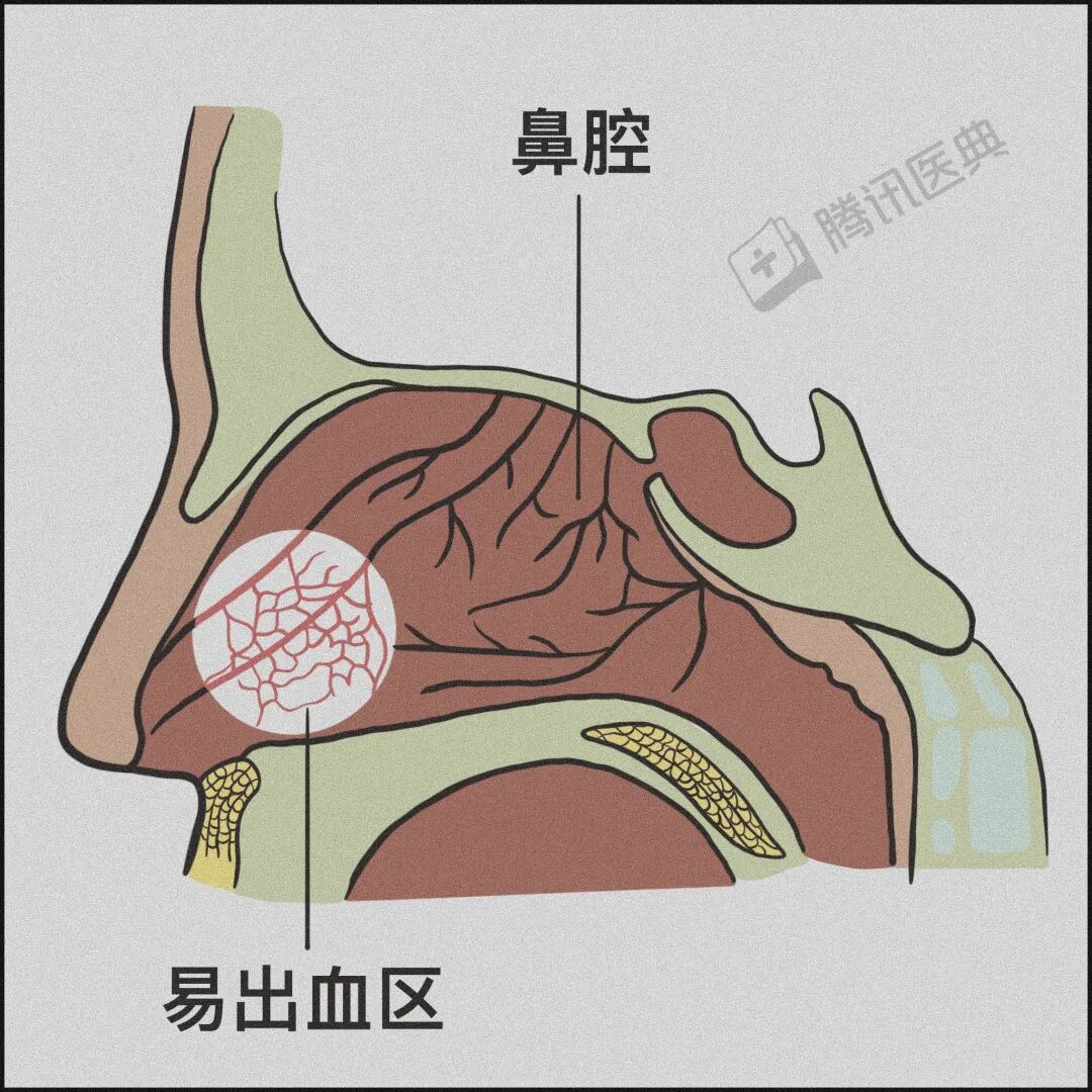 鱼刺卡喉、流鼻血仰头……别再这样“自杀式”急救了