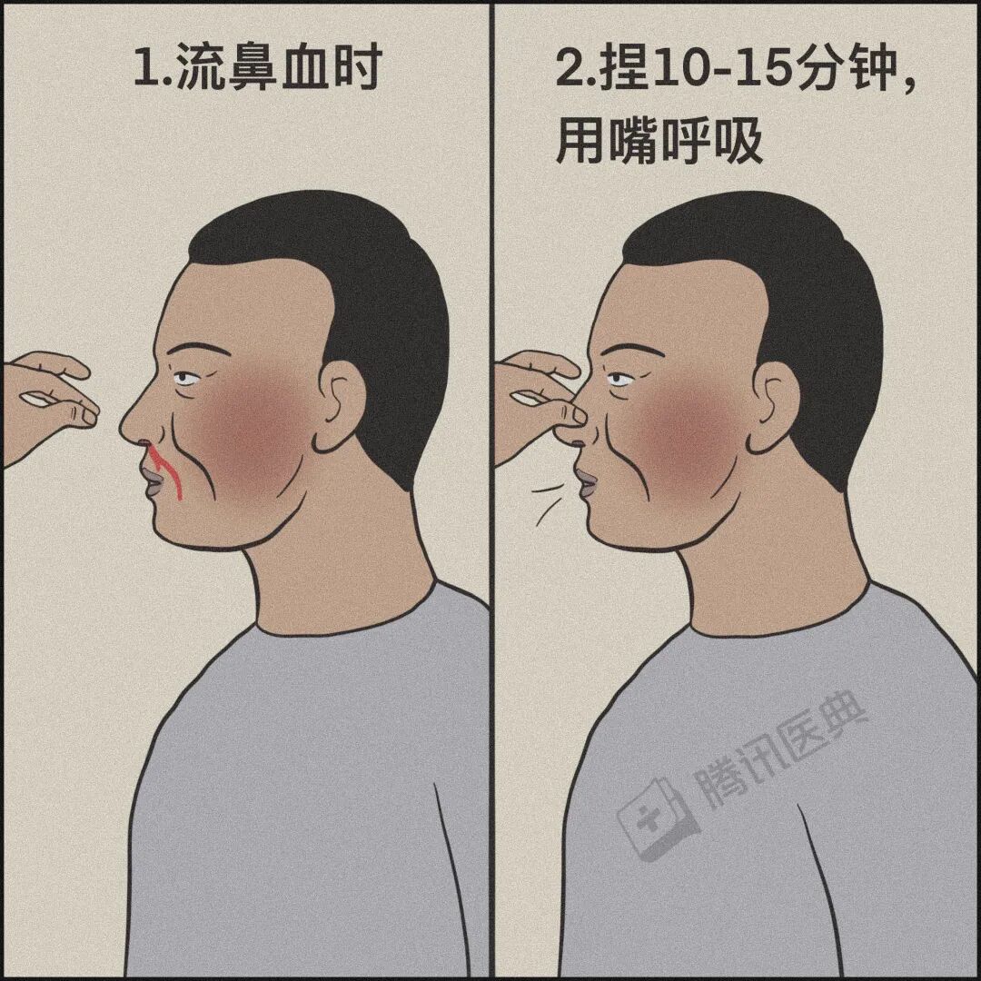 鱼刺卡喉、流鼻血仰头……别再这样“自杀式”急救了