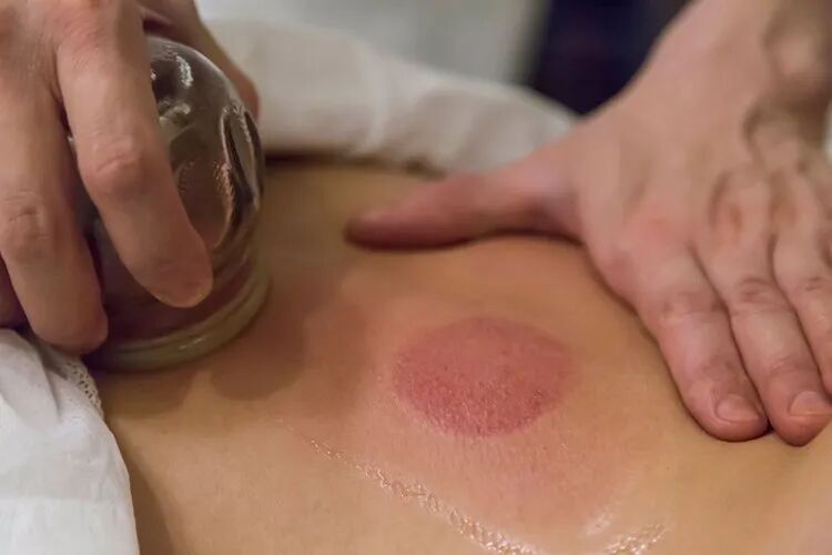 拔火罐吸出来的瘀血,是体内的毒素?告诉你真相