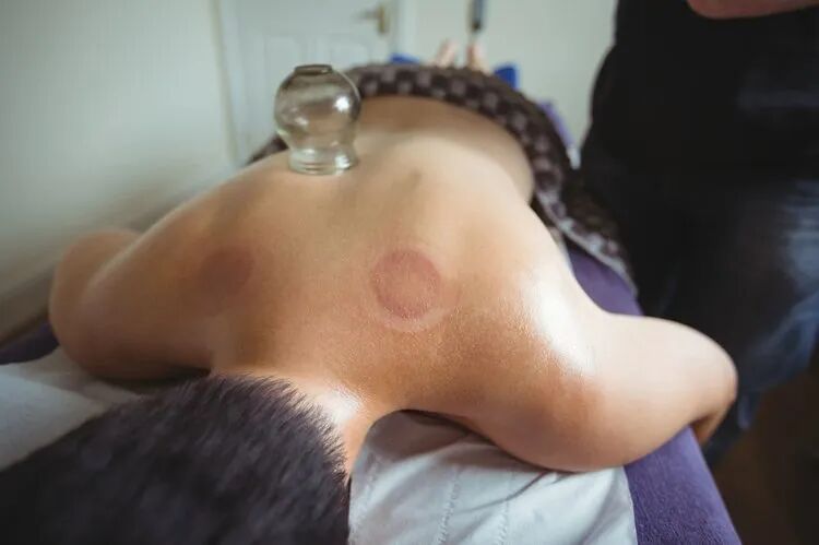 拔火罐吸出来的瘀血,是体内的毒素?告诉你真相